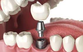 Địa điểm trồng răng implant uy tín - tại Núi Đèo Thủy nguyên